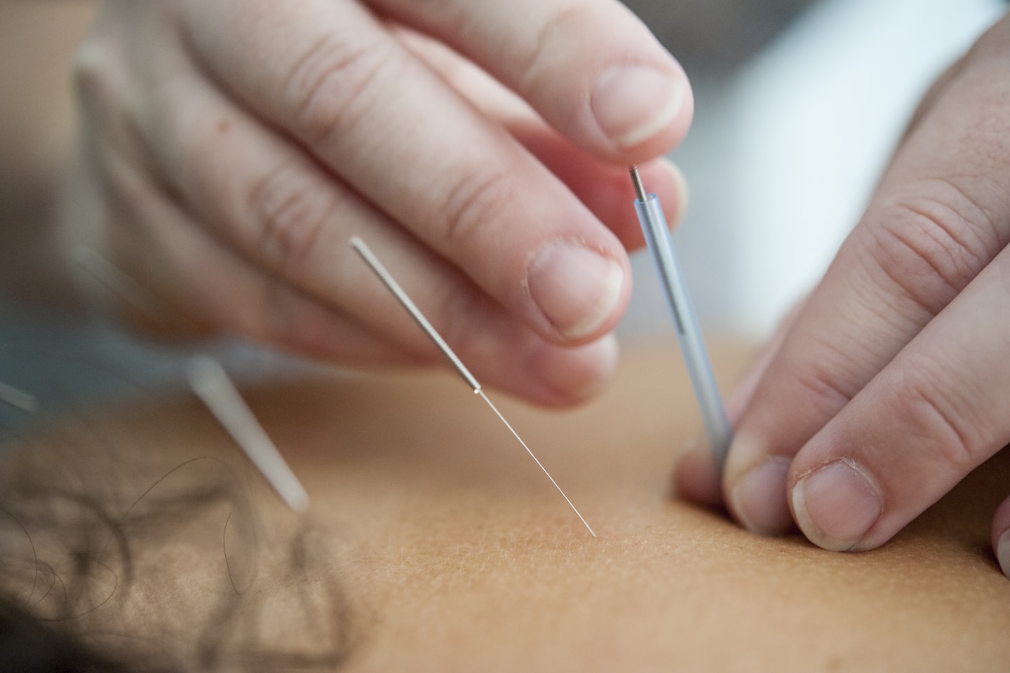 acupuncture needles inserted into skin