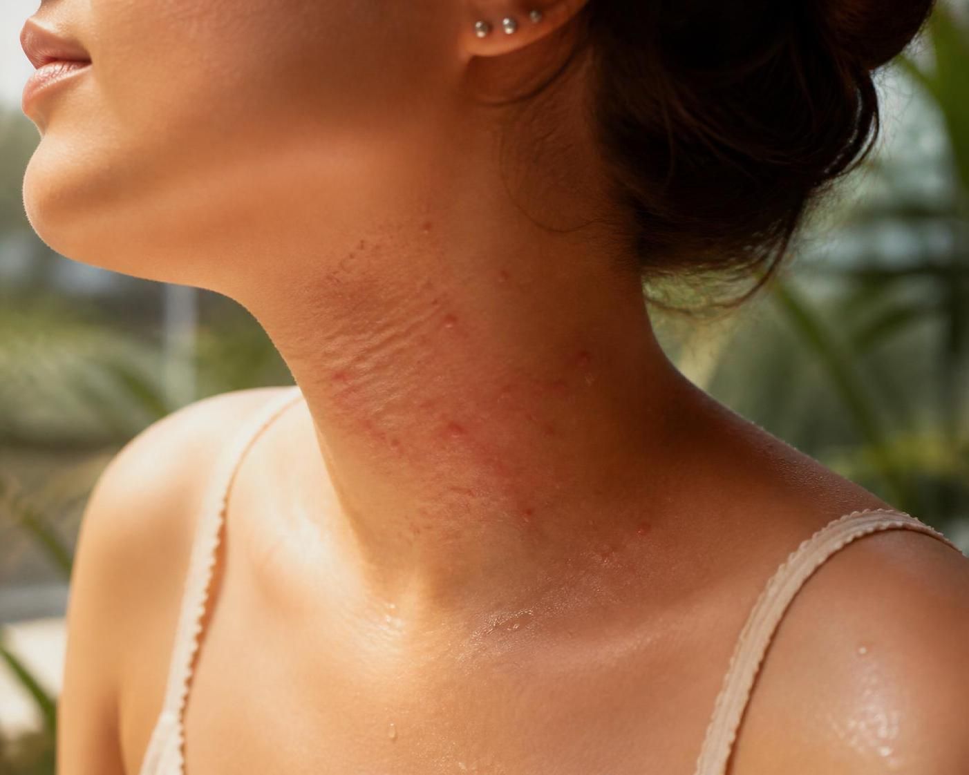 découvrez les remèdes de grand-mère efficaces pour apaiser le bouton de chaleur et soulager votre peau naturellement.